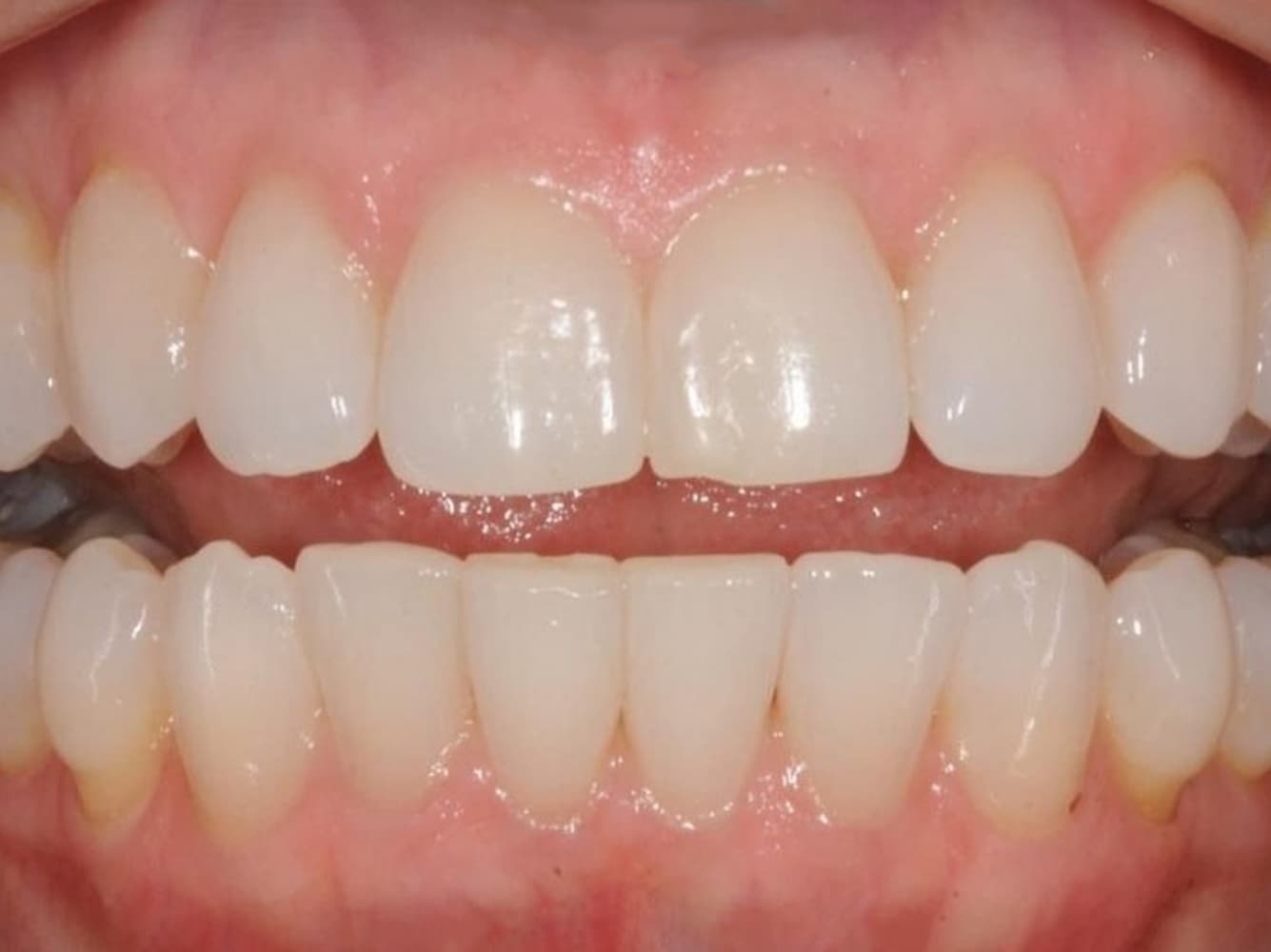 Aligners (after)