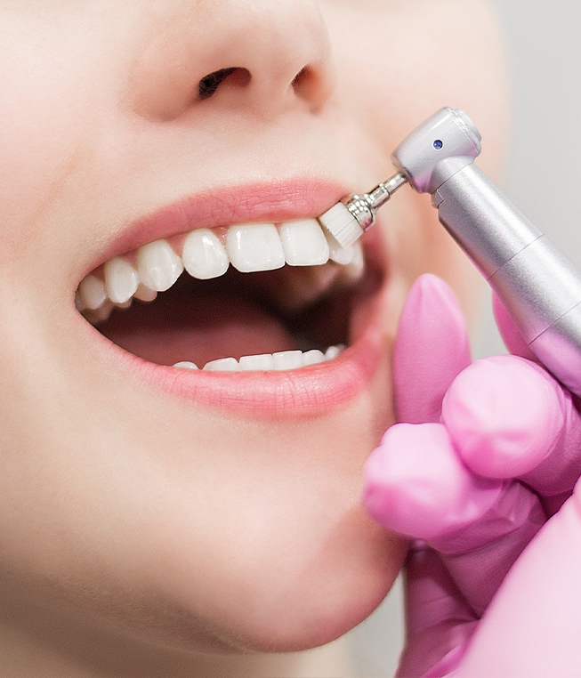 scalling_and_polishing